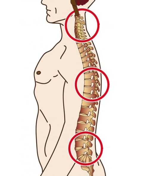osteokondrozun meydana geldiği omurga departmanları