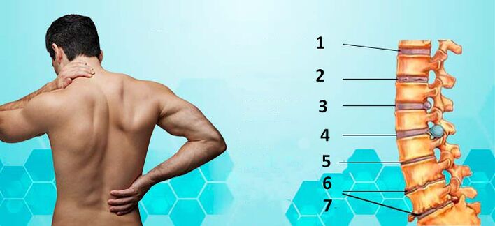 Osteokondroz gelişiminin aşamaları