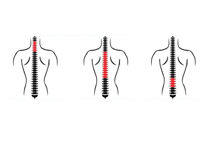 Osteokondroz nasıl ortaya çıkar