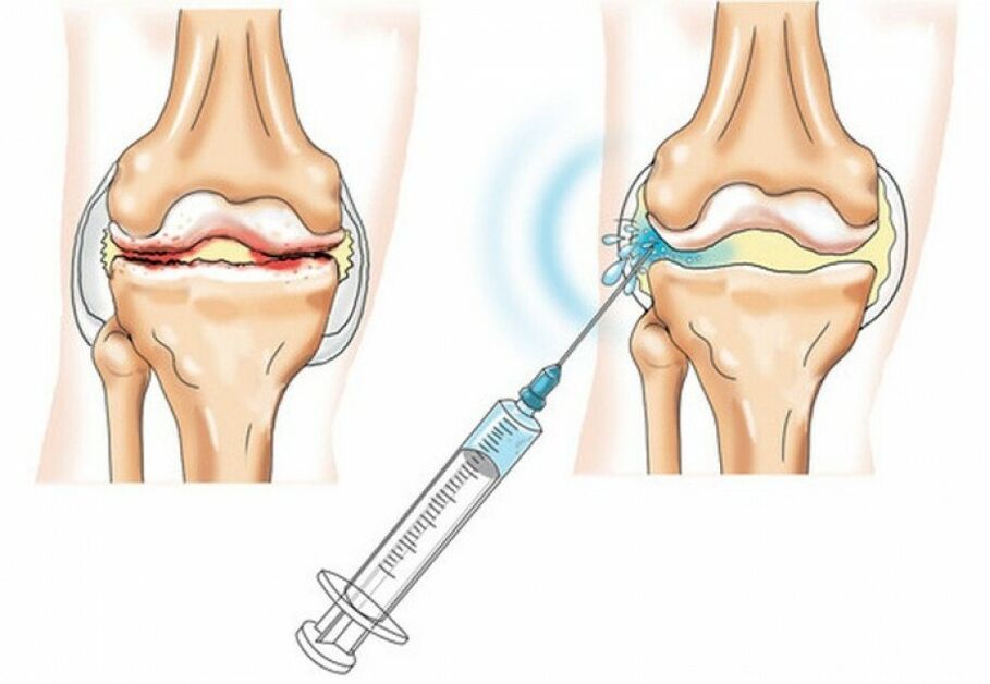 artrozlu diz eklemine enjeksiyon